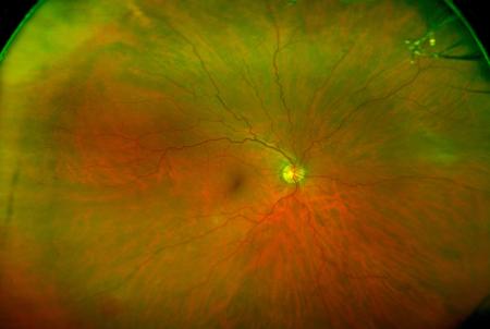 Diabetic Retinopathy